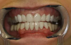 smile makeover case study - new crowns