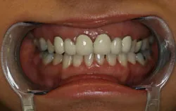 smile makeover case study - old bridge