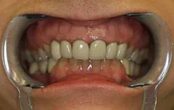 smile makeover case study - old stained crowns