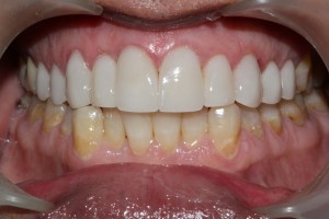 Bright white smile after a smile makeover